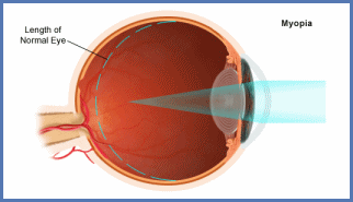 Click to find out more about Nearsightedness (Myopia)