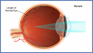 Nearsightedness (Myopia)