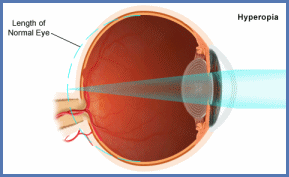 Read more: Farsightedness (Hyperopia)